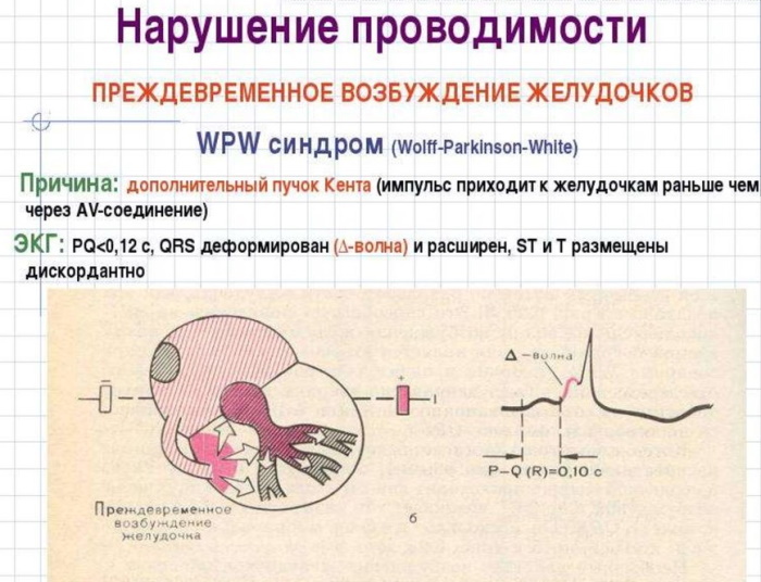 WPW (WPW) EKG -syndrom. Tecken på att det är det