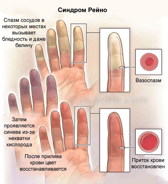 Gevoelloosheid van de handen bij vrouwen. Redenen bij nacht, dag, behandeling