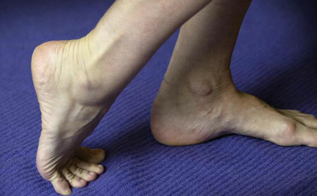 טיפול בהתכווצויות ברגליים