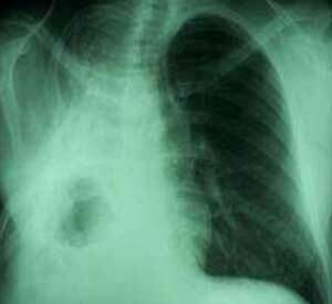 Pneumosclerosis of the lungs: what is it?