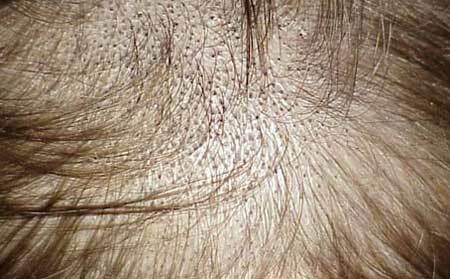 With ringworm in a person, symptoms