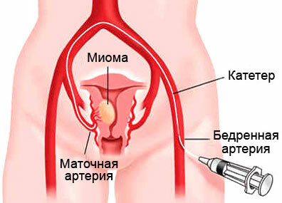 Embolisatie van baarmoedermyoma