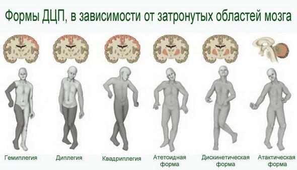 Smegenų paralyžių formos