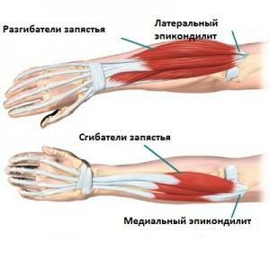 Tendinitis del codo, inflamación del bíceps