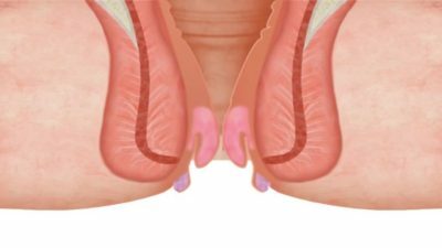 Liječenje vanjskih hemoroidnih čunjeva i čvorova: mast, supozitoriji