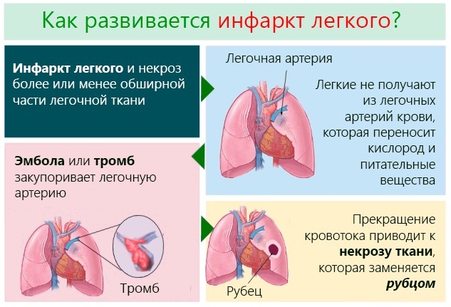 Pulmonary embolism. Symptoms, signs, diagnosis, treatment