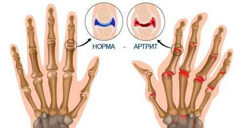 Vzroki za revmatoidni artritis