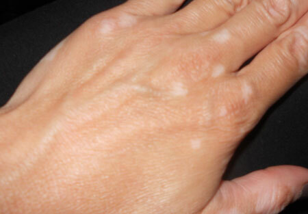vitiligo foto počáteční fáze