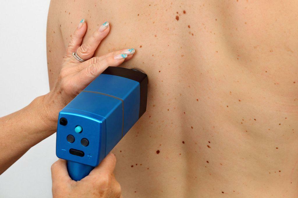 Can I remove moles on my body?
