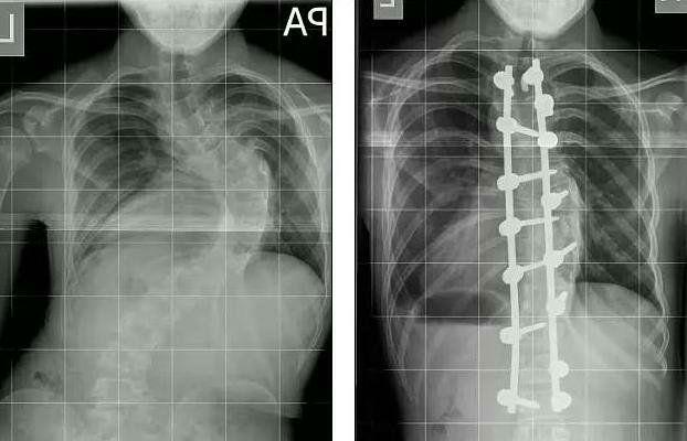 Röntgenaufnahme vor und nach der Korrektur der Wirbelsäulenverkrümmung mittels chirurgischer Methode