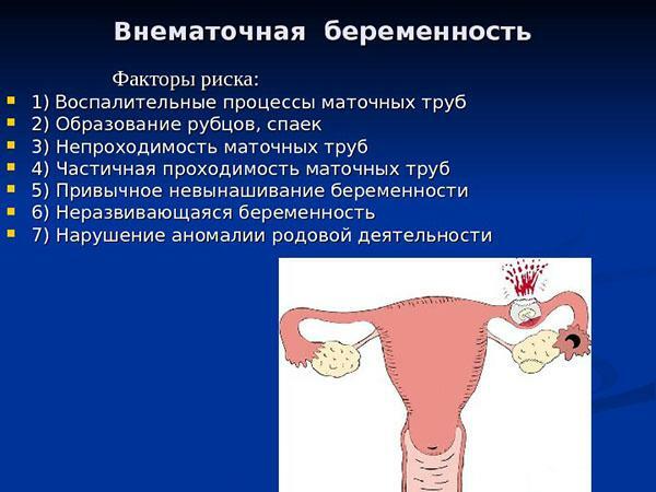 Risikofaktoren für eine Eileiterschwangerschaft