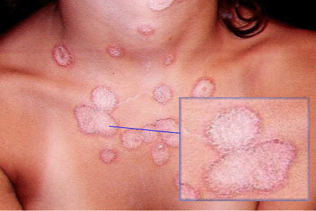Mycosis of the skin, photo