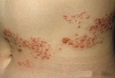 Vyöruusu( herpes zoster) on virustauti, joka ilmenee kipu ja ihon puhkeaminen