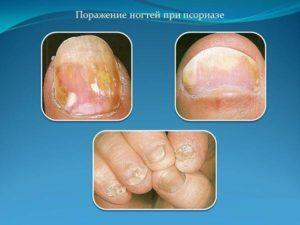 Nails with psoriasis