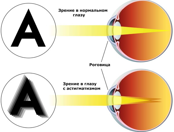 תיקון ראייה לאסטיגמציה, קוצר ראייה, היפראופיה. ביקורות