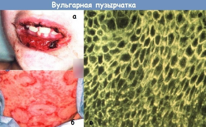 Pemphigus vulgaris: diagnostyka różnicowa