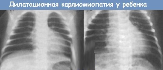 Dilated cardiomyopathy. What is it, symptoms, treatment in adults, children