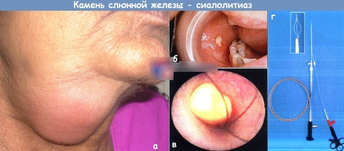 Parotid salivary gland of a person. Innervation, anatomy, histology