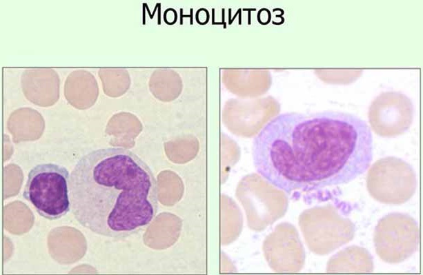 Monocytose i blodet. Hva er det, årsaker, behandling hos voksne