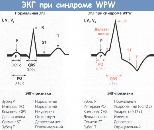 WPW (WPW) EKG -syndrom. Tecken på att det är det