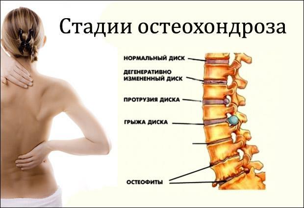 Stages of osteochondrosis of the spine