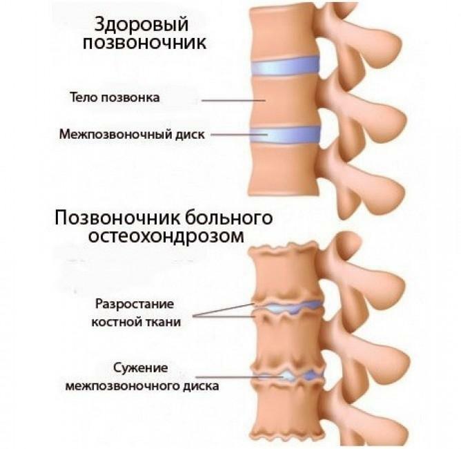 The spine with osteochondrosis