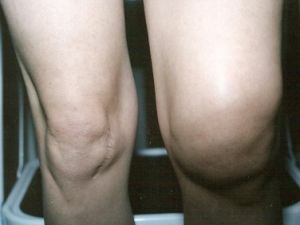 Oedeem van het kniegewricht