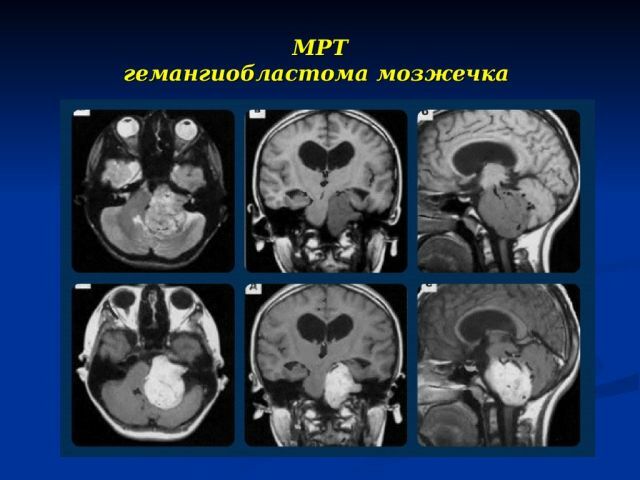 Tumor des Kleinhirns im MRT