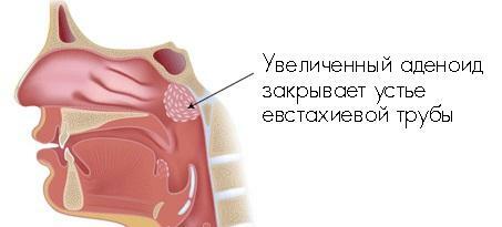 Forstørret adenoid lukker Eustachian-røret