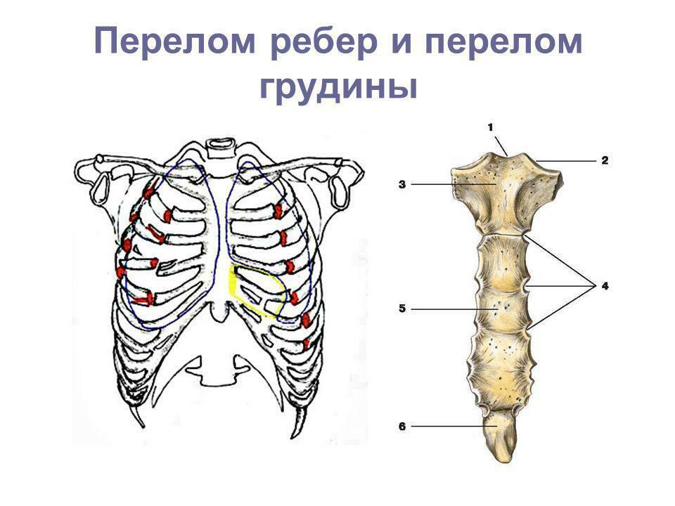 Schematické znázornění zlomeniny žeber a hrudní kosti