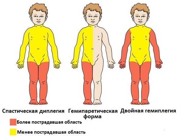 Spastic tetraparesis in children. What is it, causes and treatment