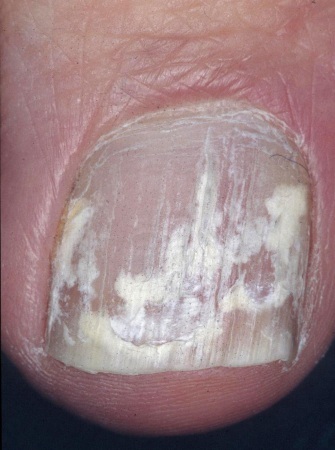 Glivice na nohtih: kako izgleda. Simptomi, zdravljenje z zdravili, ljudska zdravila