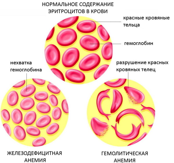 Anemija. PSO hemoglobino klasifikacija vyrams, vaikams, moterims
