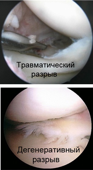 The meniscus of the knee. What is it, photo, break, damage, symptoms of illness, injury, inflammation. Treatment, surgery, removal of consequences