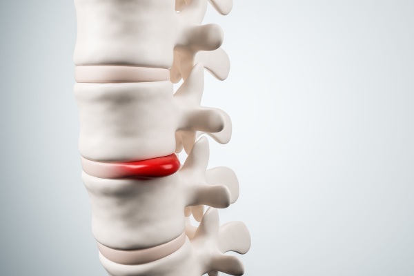Schmorl's hernia on the spine. Photo, what it is, symptoms and treatment, danger