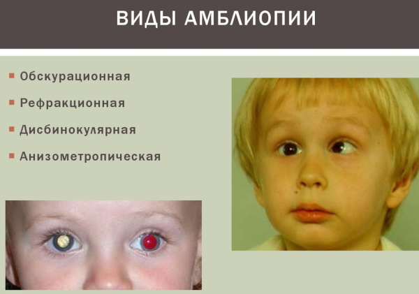 Lazy eye (amblyopia) in children. Causes and treatment