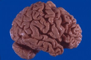 hjerneanomalier
