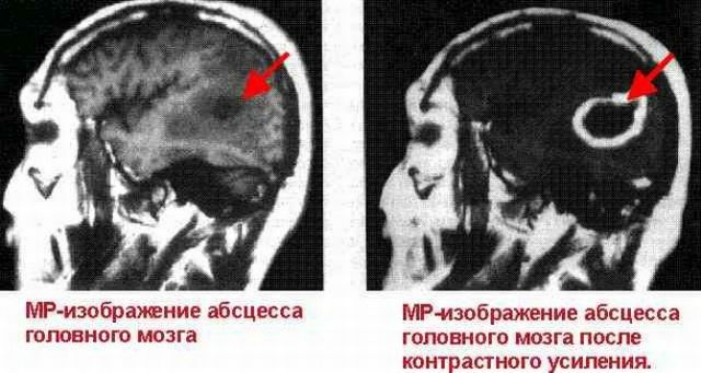 MR slika apscesa