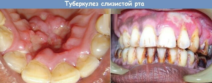 Mutes dobuma un zobu slimības. Fotogrāfijas, cēloņi un ārstēšana