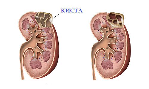 Features of development and treatment of kidney cysts