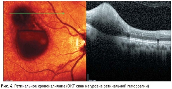 Blødning i øyet. Grunnen til hvilken lege som skal kontaktes, behandling, faller for rask resorpsjon, forebygging