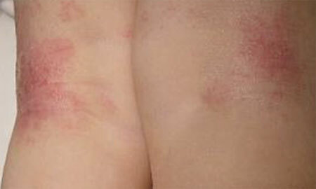 fotografija druge faze dermatitisa
