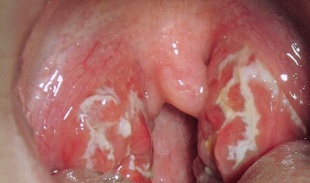 follicular sore throat in children photo