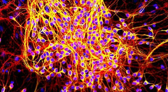 Yanlış katlanmış tau proteini nöronların beslenmesini etkileyen nörofibriler yumrular oluşturur