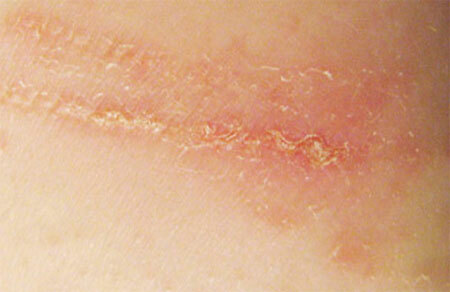 Dermatite de contact: symptômes et traitement, photo, prévention