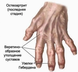 Interfalanginis artrozė: gydymas, simptomai, diagnozė