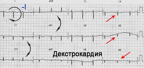 P wave (R) on the ECG. What reflects, characterizes, the norm
