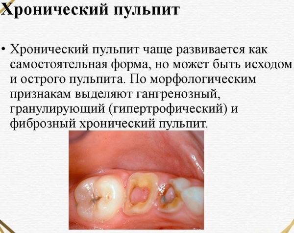 Pulpitis. Classification, diagnosis, treatment in children, adults, symptoms, causes, types