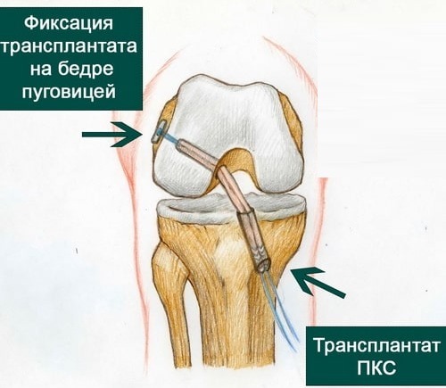 Anterior cruciate ligament. Anatomy, rupture, damage, changes, treatment