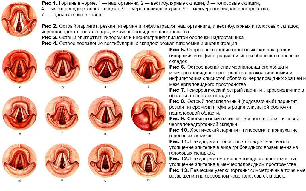 Types of laryngitis